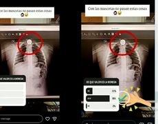 Enfermera publicó en Instagram placa realizada a niña que se tragó una moneda y fue denunciada por la familia